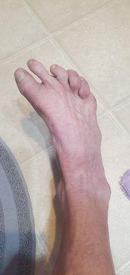 My foot Dr. "Con" botched. He got rid of my bunion alright! He left me with two toes that have no function and three claw toes!