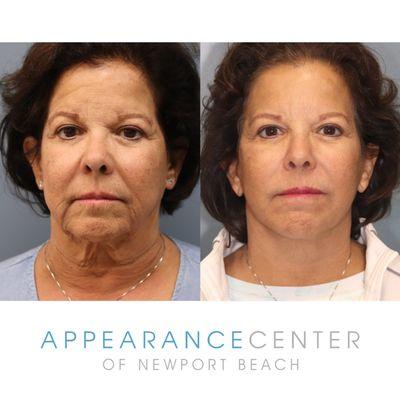 Facelift performed by Simon Madorsky, MD and Justin Karlin, MD.