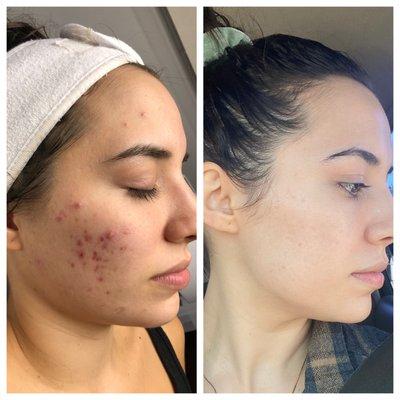 8 months on the acne protocol. SO happy with the results!