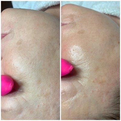 Before/After- Facial with Dermaplaning add-on and Enzyme Peel