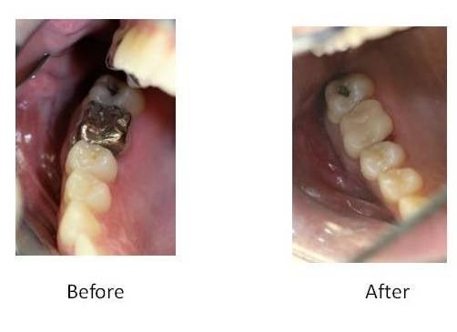 Resin (tooth colored) Fillings