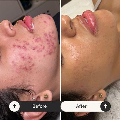 Severe acne treatment