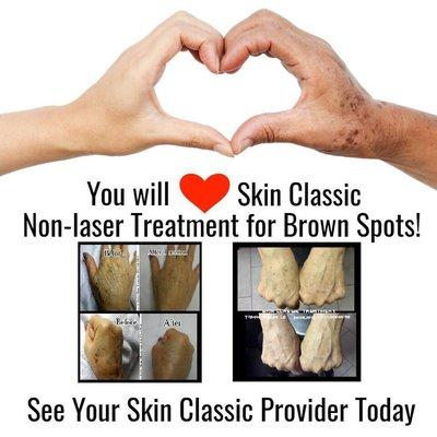 We can address skin tags, capillaries, clogged pores, large blackheads, sebaceous hyperplasia and more! Call for a free consultation