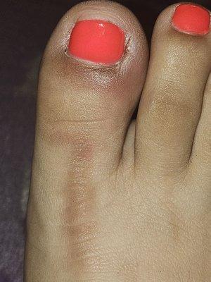 You can see my toe swollen and blood  and horrible gel nail color