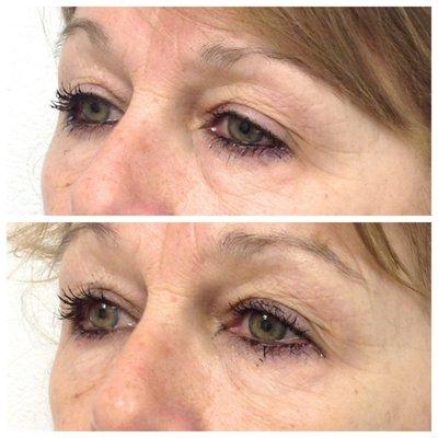 Reduction of under eye bags and puffiness