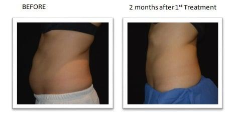 CoolSculpting Before And After