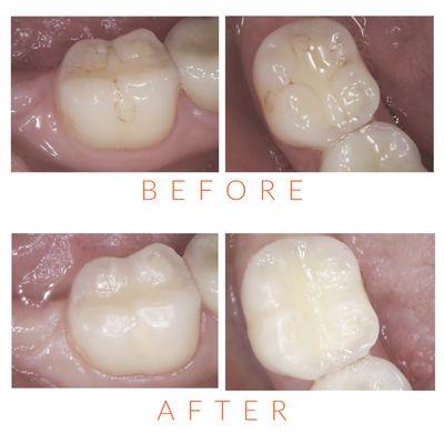 Patient had an old filling that was leaking. The filling was redone to make the tooth stronger and to significantly improve its appearance.