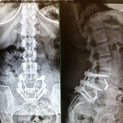 Had Spondylolisthesis, Grade 2 -- this is post-surgery (L5-S1 anterior/posterior lumbar fusion) -- a smashing success, thanks to Dr. Kim! 😃