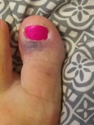 This is my toe after my pedicure. I have an infection in my bloodstream. Do not go here.