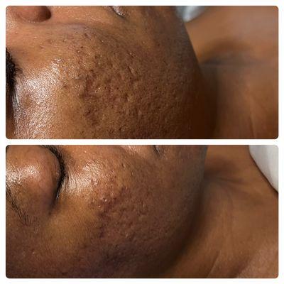 1 treatment treating Scarring