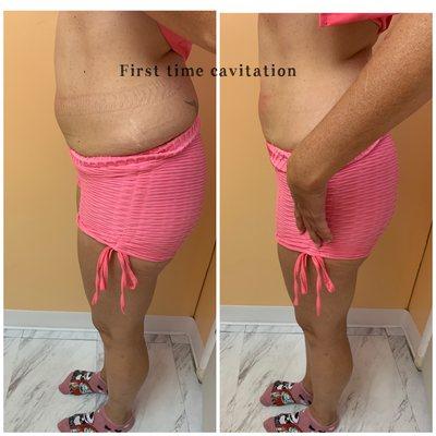 Cavitation $100 per area