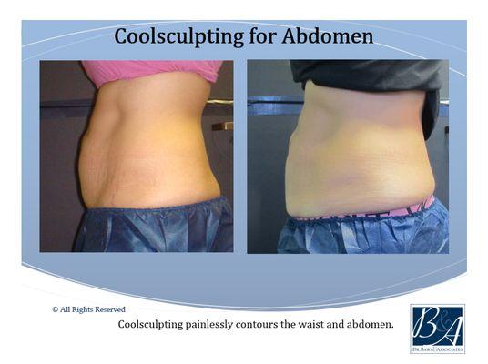 CoolSculpting for Abdomen