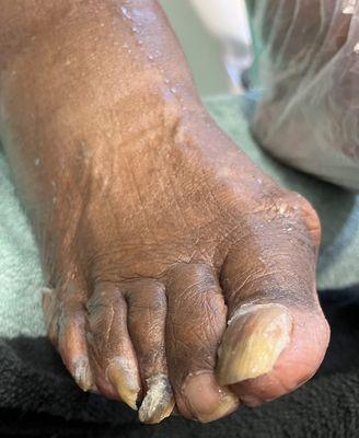 Before Pedicure