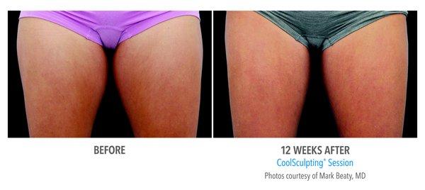 Check out these amazing Coolsculpting results!