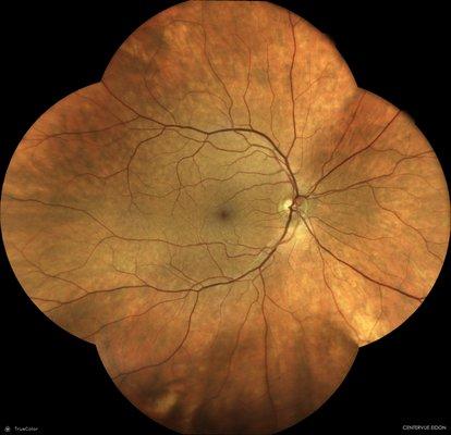 Retinal photos of the right eye