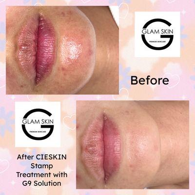 Before and after CIESKIN Treatment 
Best Korean Skincare for Acne or blemished Skin