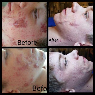 Poshe' Clear Skin Program is designed to get your acne under control and cleared in 90 days