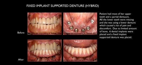 Fixed Implant Supported Denture (Hybrid)