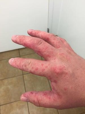 They knew he was allergic to this stuff but gave it to him anyway.  Pharmacist said he's lucky to be alive.   Never even got an apology.