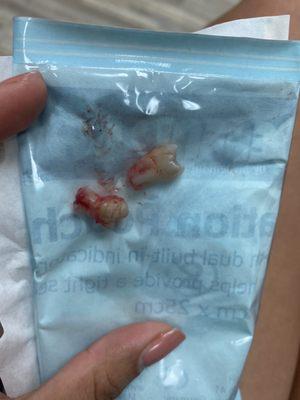 Two wisdom teeth that were extracted.