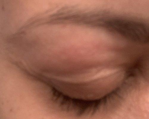 Cut and swollen eyelid from threading.