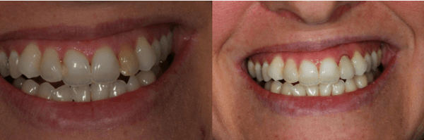 Before & After Results at The Office of Keith G. Lorio, DDS| Baton Rouge, LA