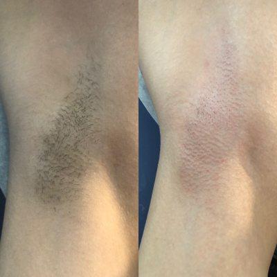 Before and after of waxed underarms.