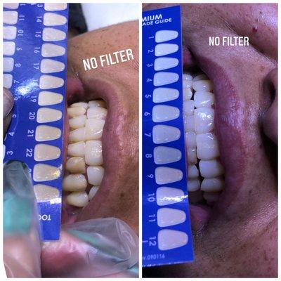 Teeth bleaching