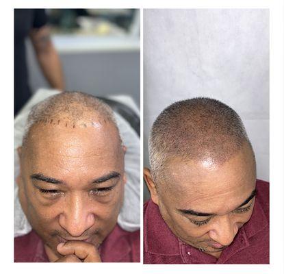 Before and After 1 session Scalp Micropigmentation