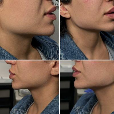 jawline filler