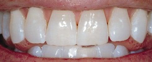 After...Whitening!