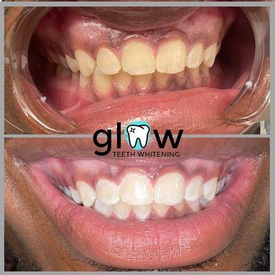 Glow Teeth Whitening