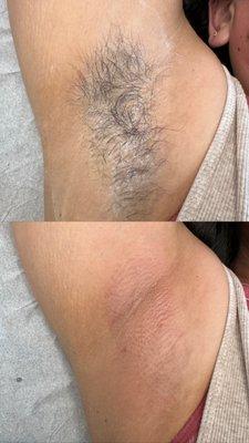 Underarm wax