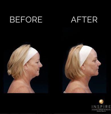 Before and after neck liposuction to reduce the double chin by one of Inspire Cosmetic Surgery & Med Spa's Board Certified Plastic Surgeons.