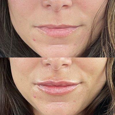 Before and after one treatment of filler on top lip