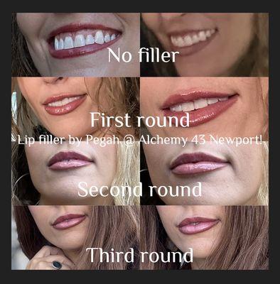 Lip injections by Pegah. I love them so much. Pegah is very talented. Heather and Haley at the front are so awesome too!