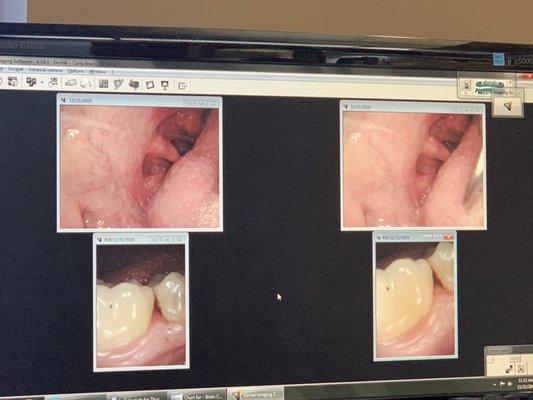 I need to get one more filling on back molar,  and I had a sore throat,  that's my my tonsils are inflamed lol.