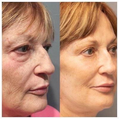 Complete Facial Rejuvenation