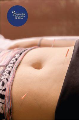 A pediatric acupuncture treatment.