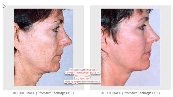 Thermage   before after https://sites.google.com/view/thermage-ny/more-thermage