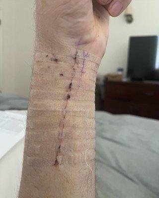 Pretty straight incision....