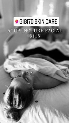 Acupuncture Facial