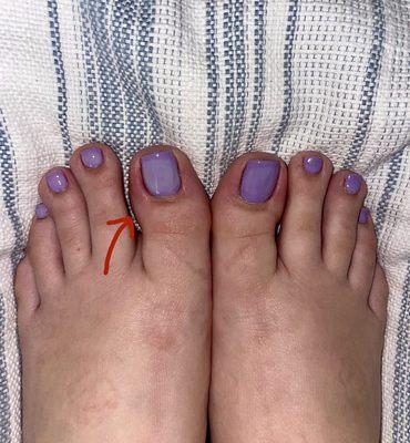 You can see where the redness and swollen toe is beginning to take place. OUCH!