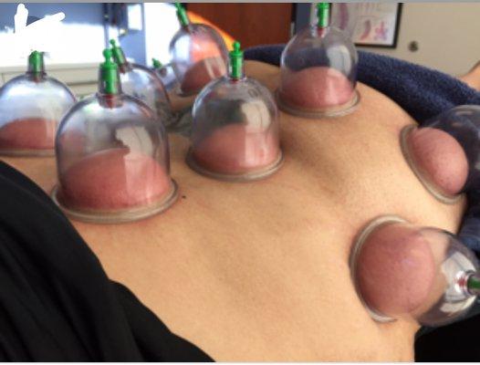 Cupping available helpful to break up adhesions