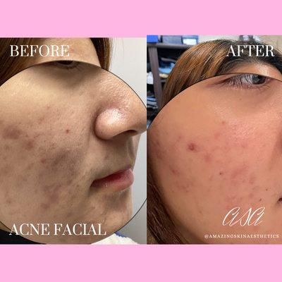 Can you believe these incredible next day results after just ONE session of The Works acne facial treatment at Amazing Skin Aesthetics?