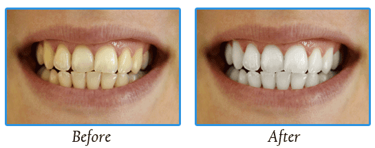 ZOOM Teeth Whitening