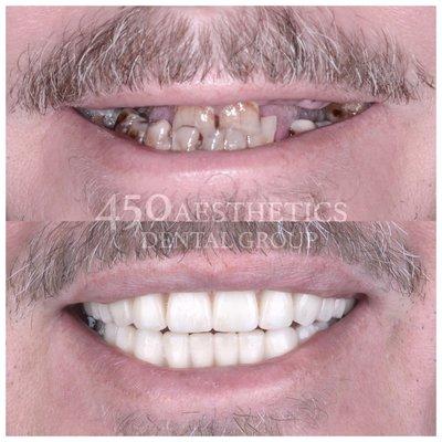 Smile makeover and full mouth rehabilitation with implant supported dentures