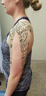 Taping helps support the rotator cuff while allowing movement at the joint. Taping helps reduce pain and accelerate the healing process