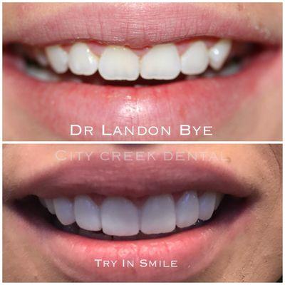 Another SMILE TEST DRIVE. Lengthening the teeth give a much more esthetic look and give this patient a more symmetrical and full smile.