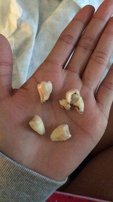 You have the option of bringing your wisdom teeth home!